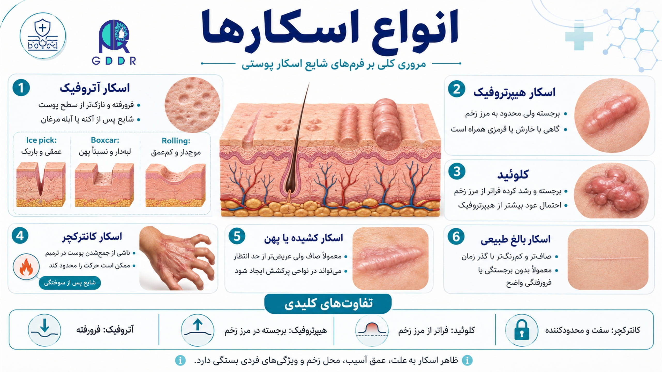 انواع مختلف اسکار و شاخصه های هر یک در یک تصویر اینفوگرافیک