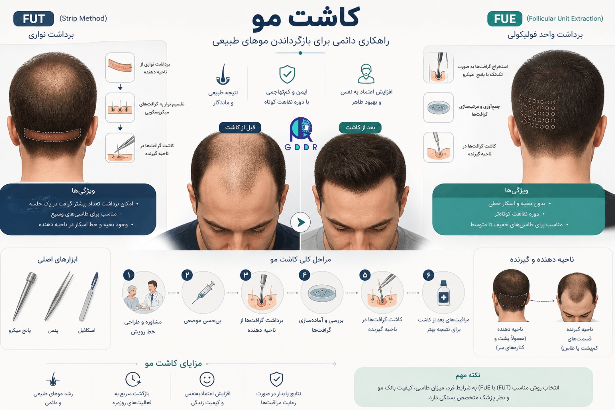 دوره آموزش کاشت مو