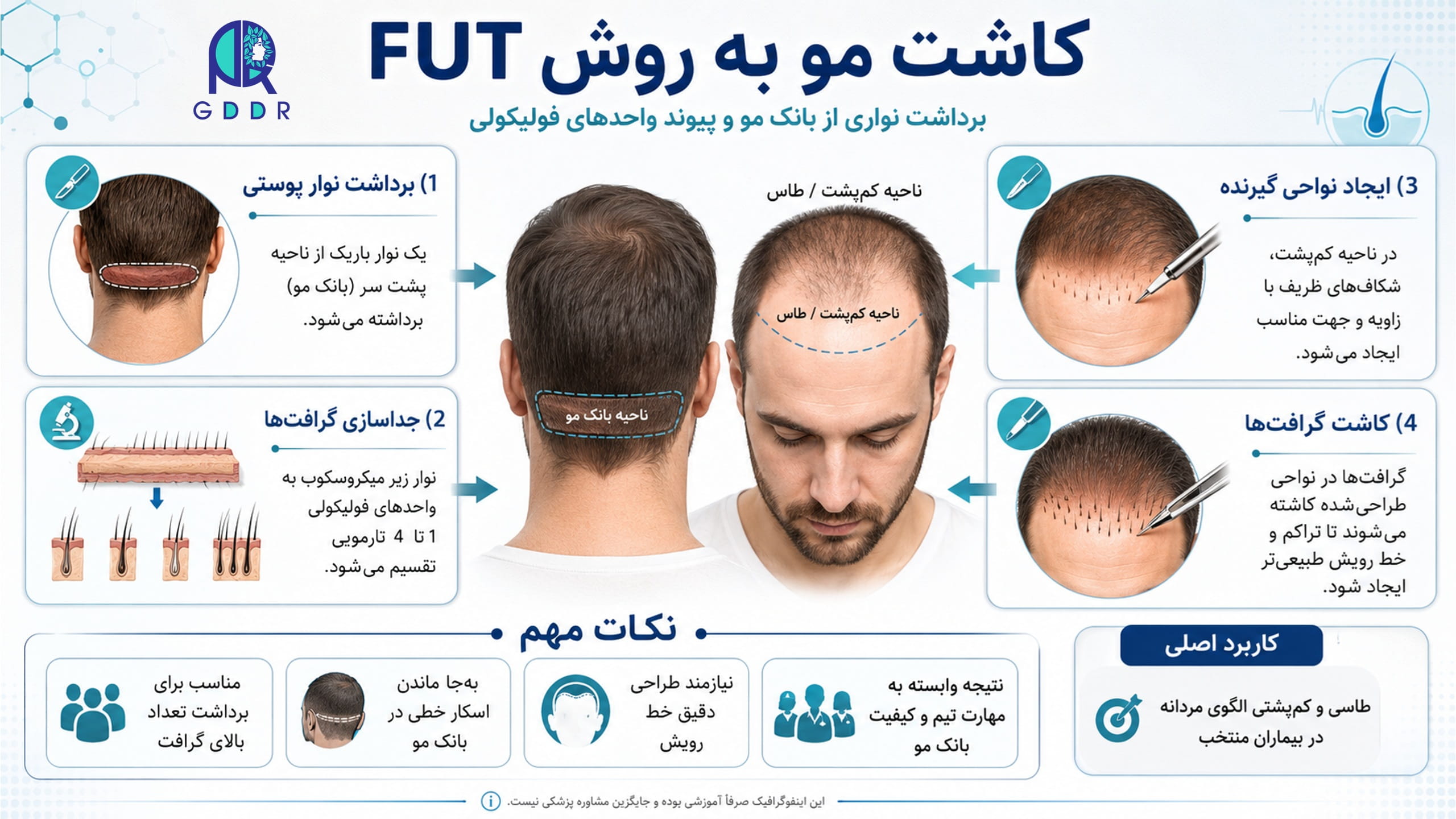 کاشت مو به روش FUT و انچه باید بدانیم بصورت اینفوگرافیک