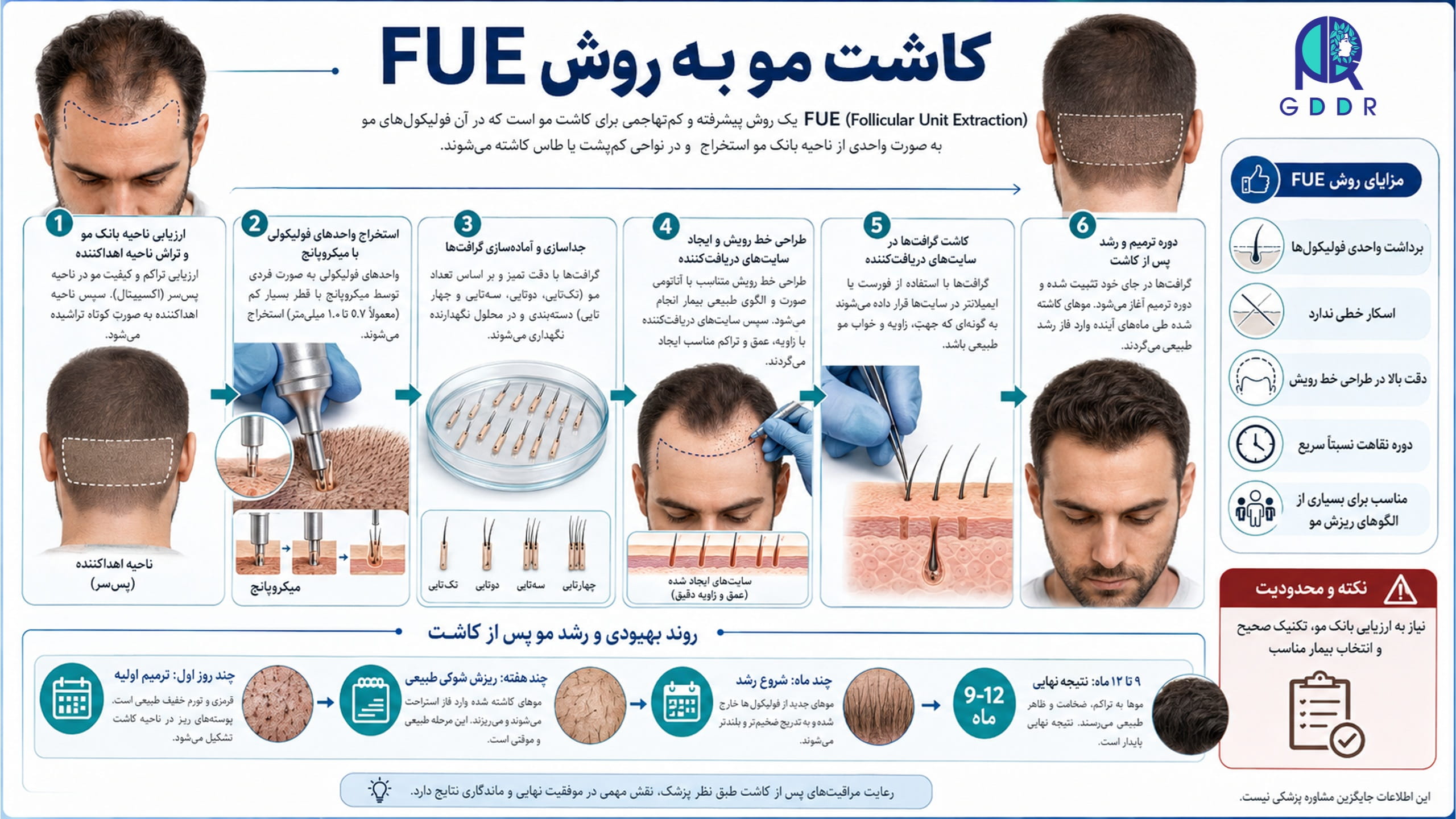 کاشت مو به روش FUE و جزئیات آن بصورت اینفوگرافیک