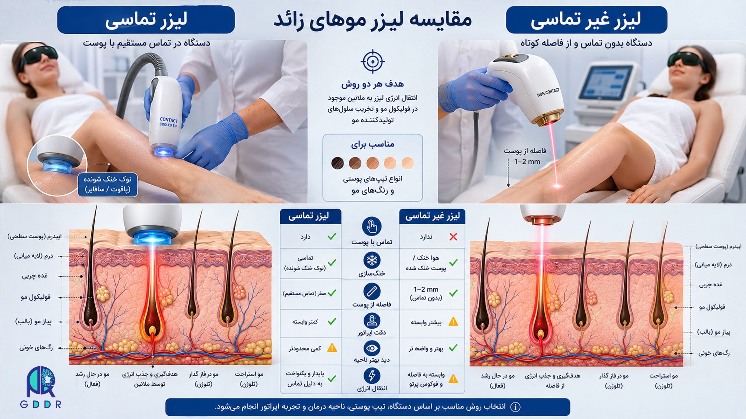 اموزش لیزر رفع موهای زاید