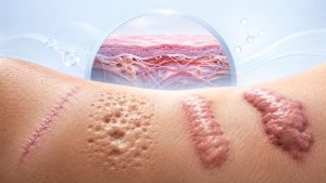 دنیای اسکارها، تصویر اصلی مقاله - درمان اسکار، اسکارتراپی، انواع اسکارها