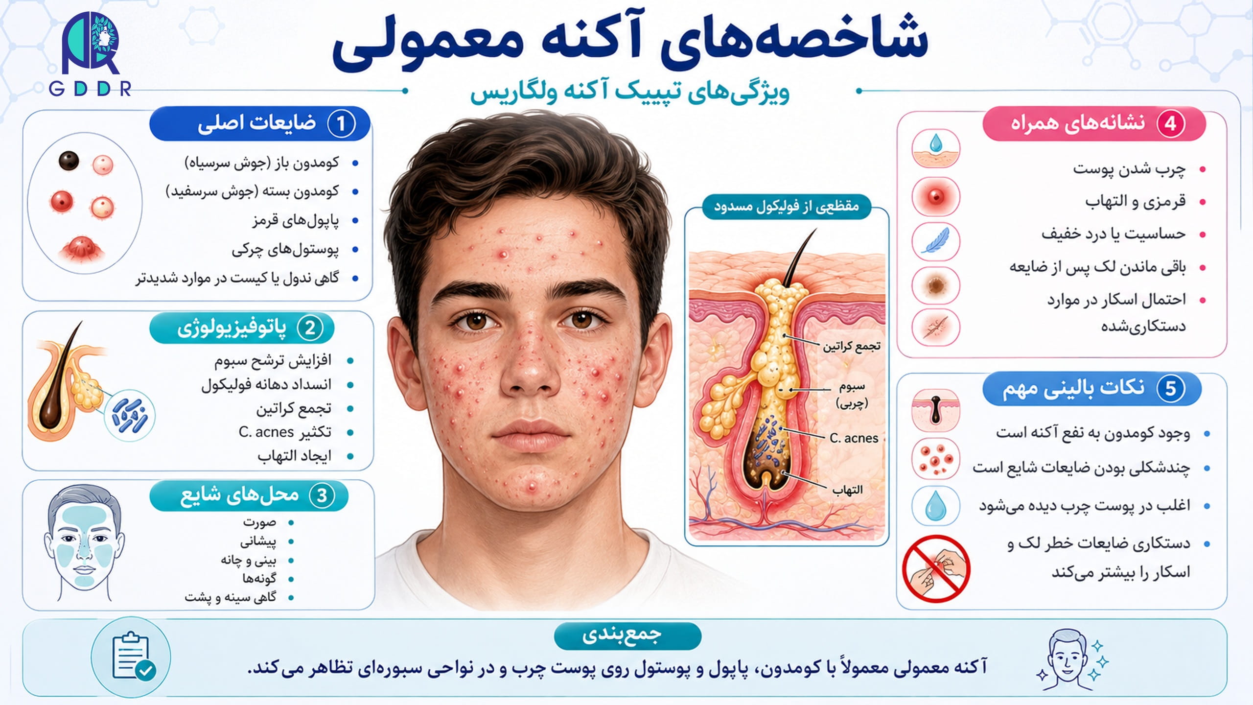 شاخصه های آکنه معموملی برای بهبود روند تشخیص آکنه از دیگر اختلالات شبه آکنه در یک تصویر اینفوگرافیک