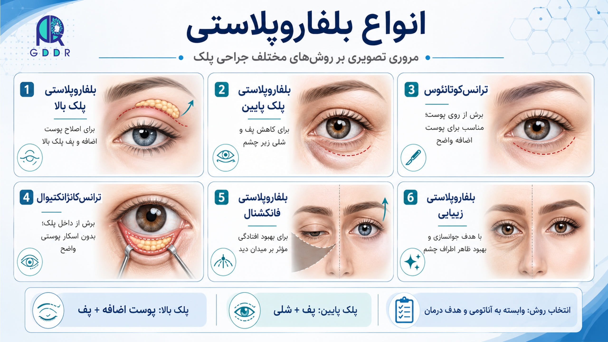 انواع مختلف بلفاروپلاستی در یک تصویر جامع اینفوگرافیک
